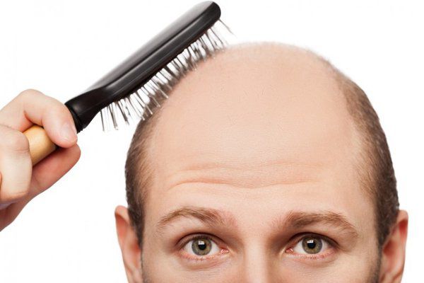 Thuốc mọc tóc cho nam minoxidil  an toàn đơn giản tiện lợi